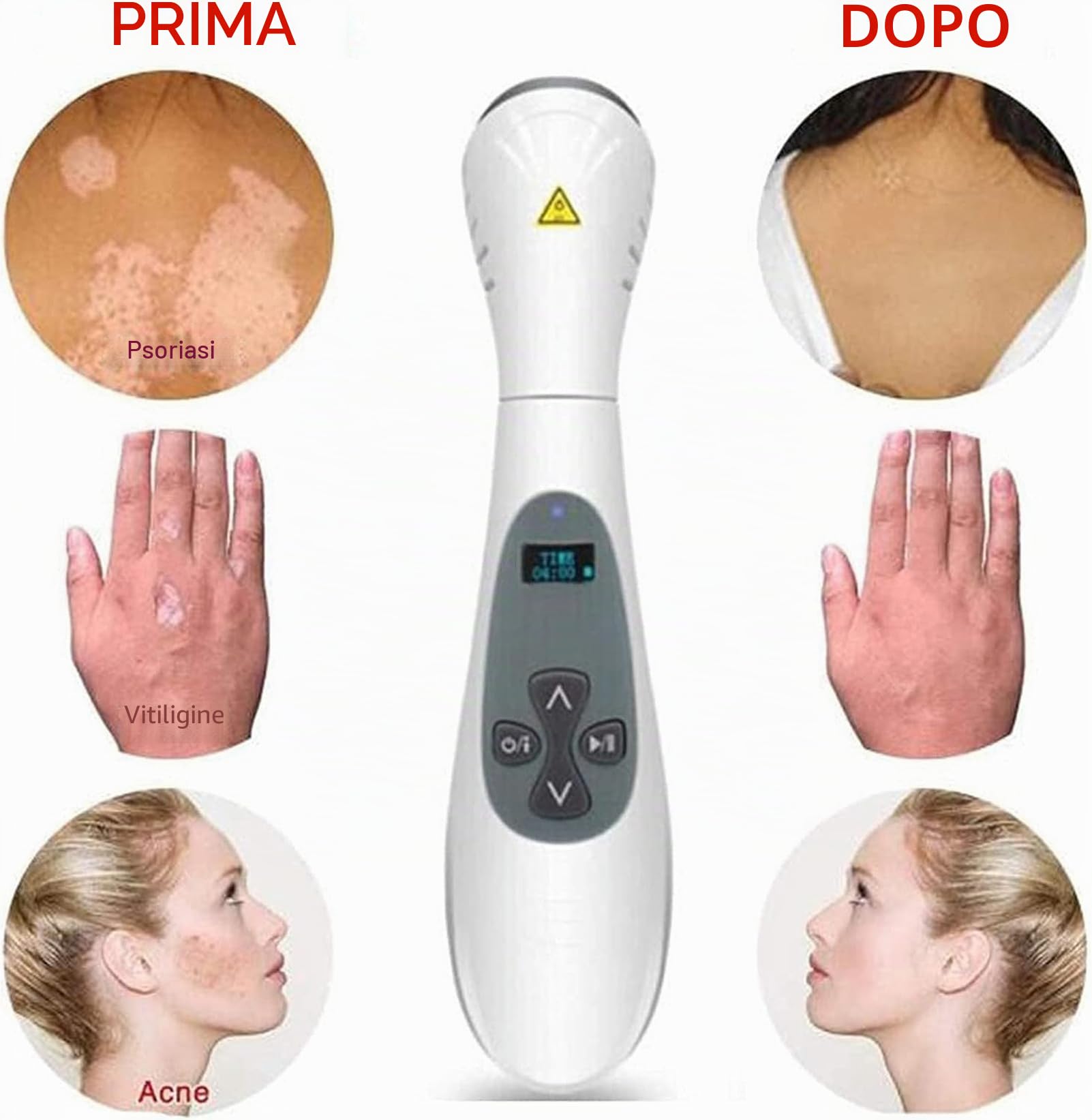 Lampada per Fototerapia UVB, Lampada per Fototerapia a Luce UVB a Banda Stretta da 308 NM con Controllo Timer Digitale LCD, per Disturbi della Pelle, Corpo E Cuoio Capelluto