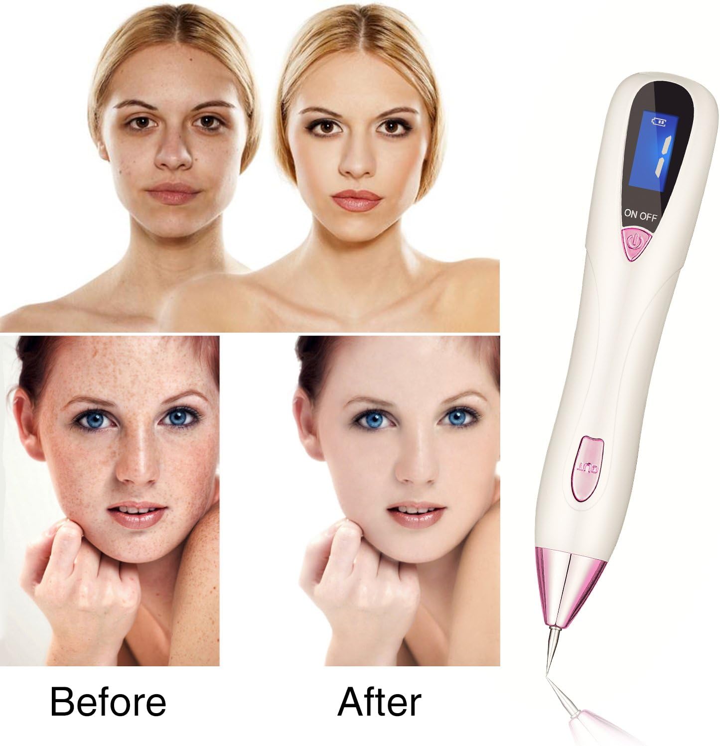 Wart and Skin Tag Remover Pen - Advanced at-Home Removal Kit Beauty Tool, Model CTS-15