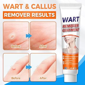 Skin Tag Remover and Verruca Treatment, 20g Wart Removal Cream for Effective and Safe Results. Gently Removes Corns on Feet and Hands, Keeps Skin Smooth and Healthy (20g)
