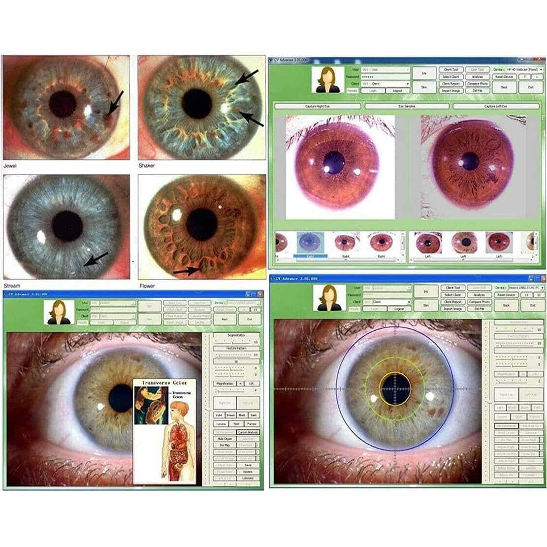 Cámara De Análisis De Iris,Cámara De Iridología con Analizador De Iris USB De 5.0 MP,Irisoscopio USB,Lupa Iris,Cámara Iris Ocular,Cámara Análisis Iris,con Lente Iris 30x Y Software Análisis