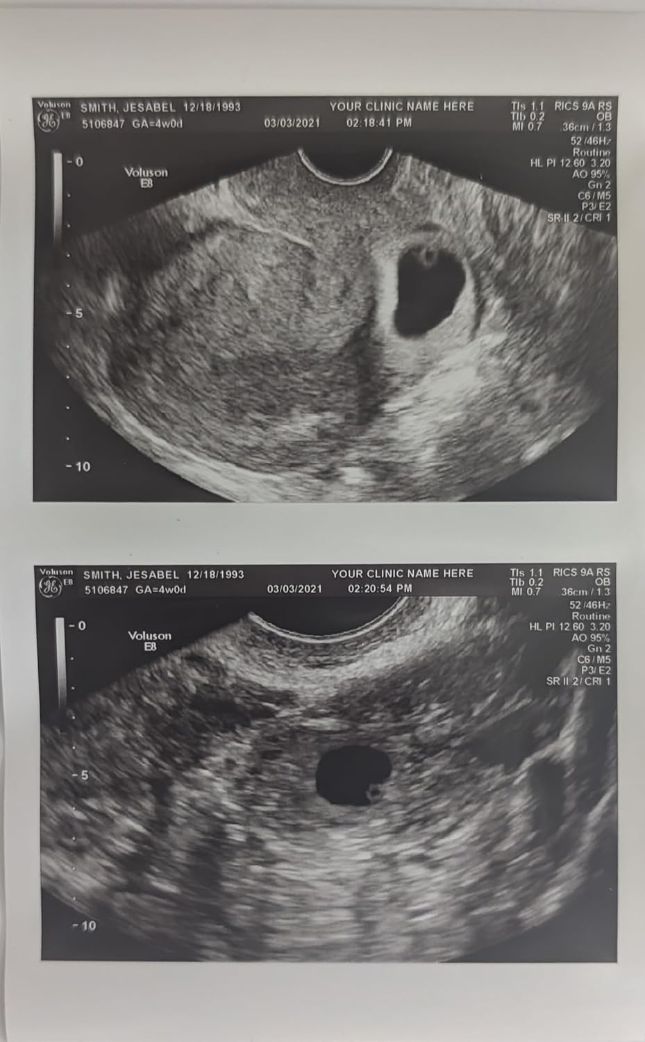 Prank 2D Customized Fake Ultrasound Two Photos Connected B&W