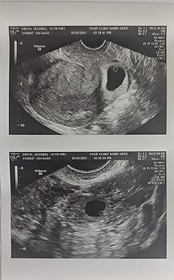 Prank 2D Customized Fake Ultrasound Two Photos Connected B&W