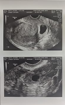 Prank 2D Customized Fake Ultrasound Two Photos Connected B&W