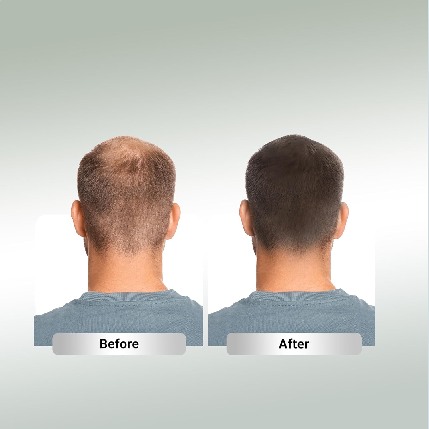 RE’Volte Hair Regrowth Treatment – Scientifically Formulated & Doctor Recommended – Powerful DHT Blocker for Hormonal Hair Loss – Skin, Hair & Nails Supplement – 661mg, 60 Capsules, 30-Day Supply