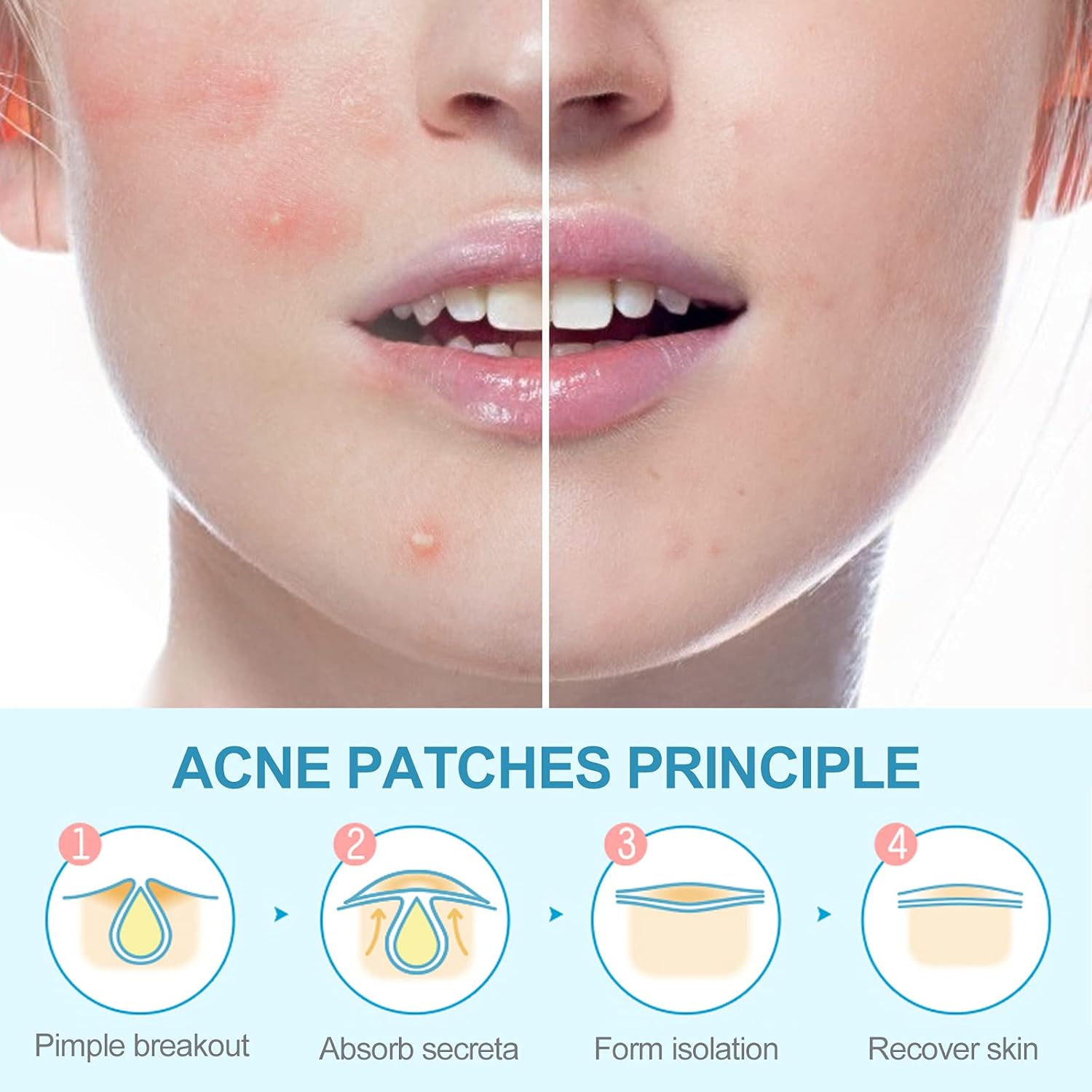 Beautyher Pimple Patches Acne Patches, 180 Patches 4 Sizes Zit Patch Hydrocolloid Patch, Invisible Acne Patches For Face Acne Absorbing Cover Patch Pure Natural Ingredients - 1 Pack : Beauty & Personal Care