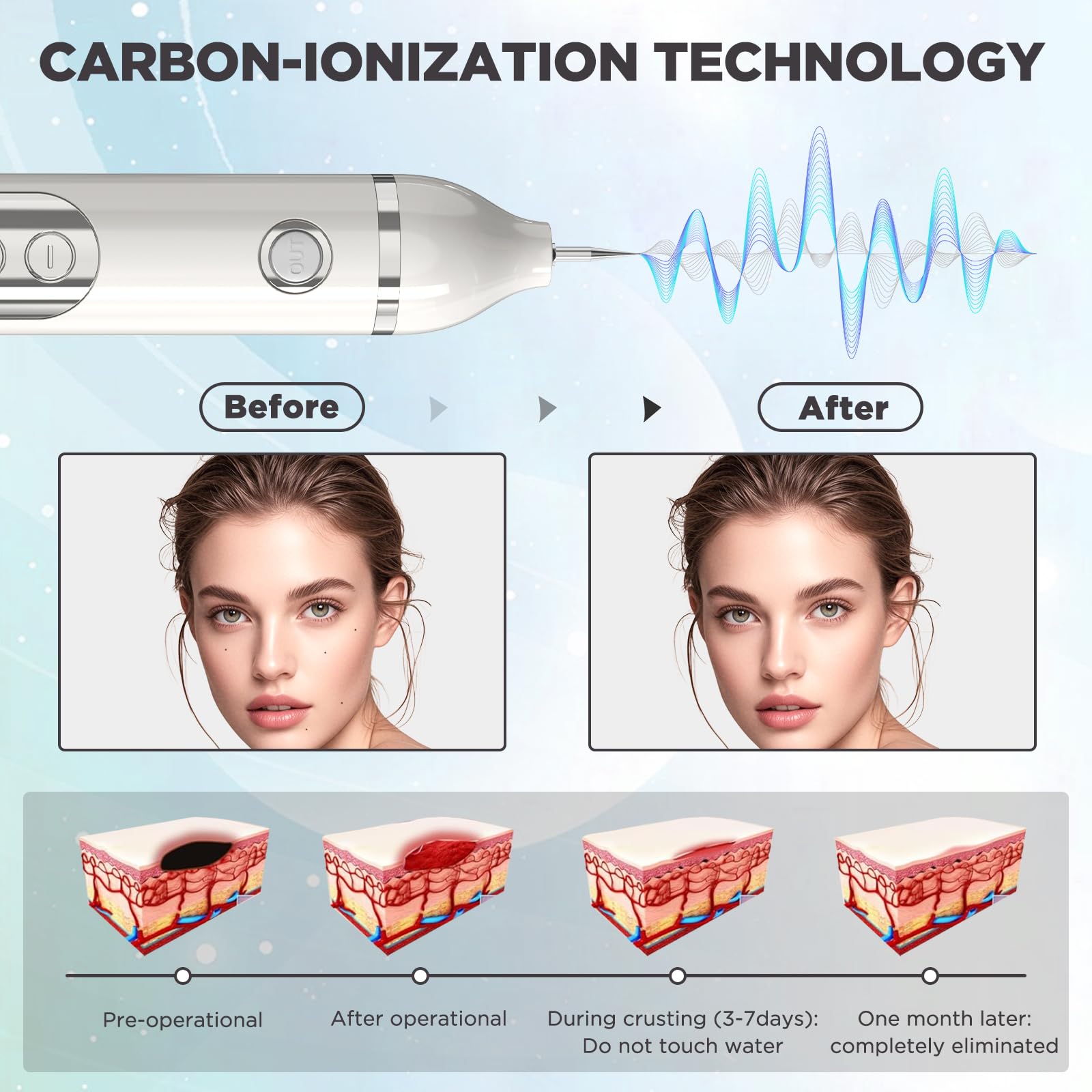 Eliminar Verrugas, Lápiz Para Eliminar Verrugas Cutáneas Lápiz Para Eliminar Lunares con Plasma 19 Niveles De Intensidad y Luz LCD Aguja Reemplazable para Rostro Cuerpo Verrugas Pecas Nevos