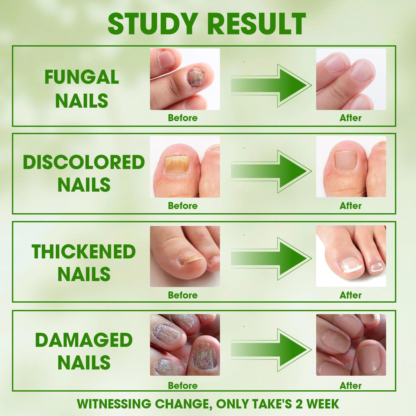Kit de tratamiento de hongos en las uñas de los pies, sistema completo de 4 pasos con solución para el cuidado de uñas, aceite de cuidado, crema de cuidado y parches de uñas, incluso dirigido para el 6