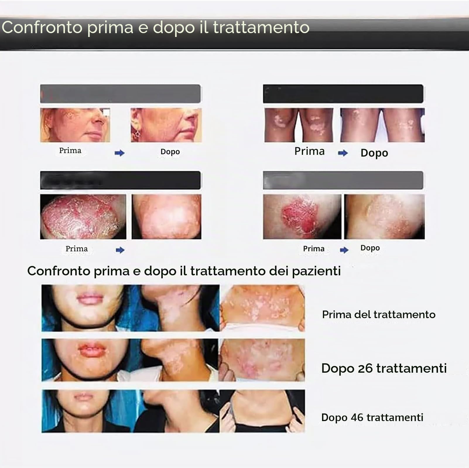 Luci UVB Per La Cura Della Pelle, Luce Per Fototerapia a Banda Stretta Per Terapia Della Luce Da 311 Nm Con Controllo Timer LCD Digitale E Occhiali Di Sicurezza, Per Pelle,Corpo E Cuoio Capelluto