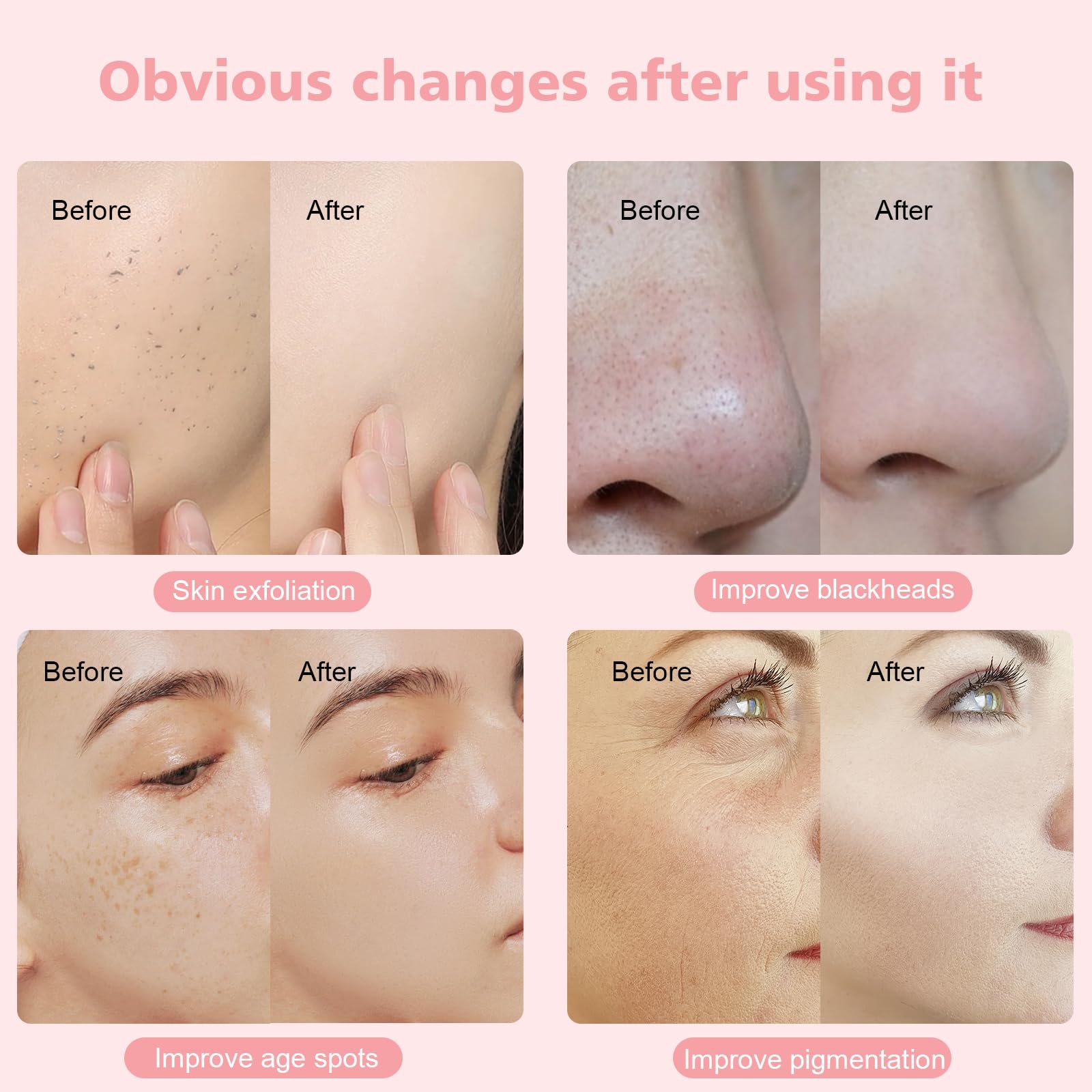 3 in 1 Dispositivo di dermoabrasione professionale, barra magica speciale per centri estetici, flaconi spray, tubi di vetro sottovuoto e altre attrezzature professionali per (Rosa)