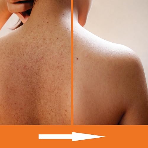 Miniatura 3 de Jabón corporal exfoliante con ácido salicílico  Exfolia suavemente la piel áspera y con baches, gel de baño para el acné corporal, con BHA y AHA