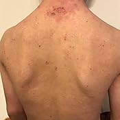 アトピーが消えちゃった マンガでわかる体質改善 佐々木愛 伊藤龍一 美容 ダイエット Kindleストア Amazon