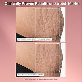 StriVectin SD Advanced Plus Intensive Moisturizer for Wrinkles and Stretchmarks, For Face and Body, Collagen Boosting with Peptides and Hyaluronic Acid, 4 Fl Oz (Pack of 1)