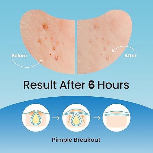 Miniatura 7 de Paquete de parches ultra invisibles para manchas oscuras y parches de espinillas grandes para tratamiento posterior al acné, uso diurno y nocturno,
