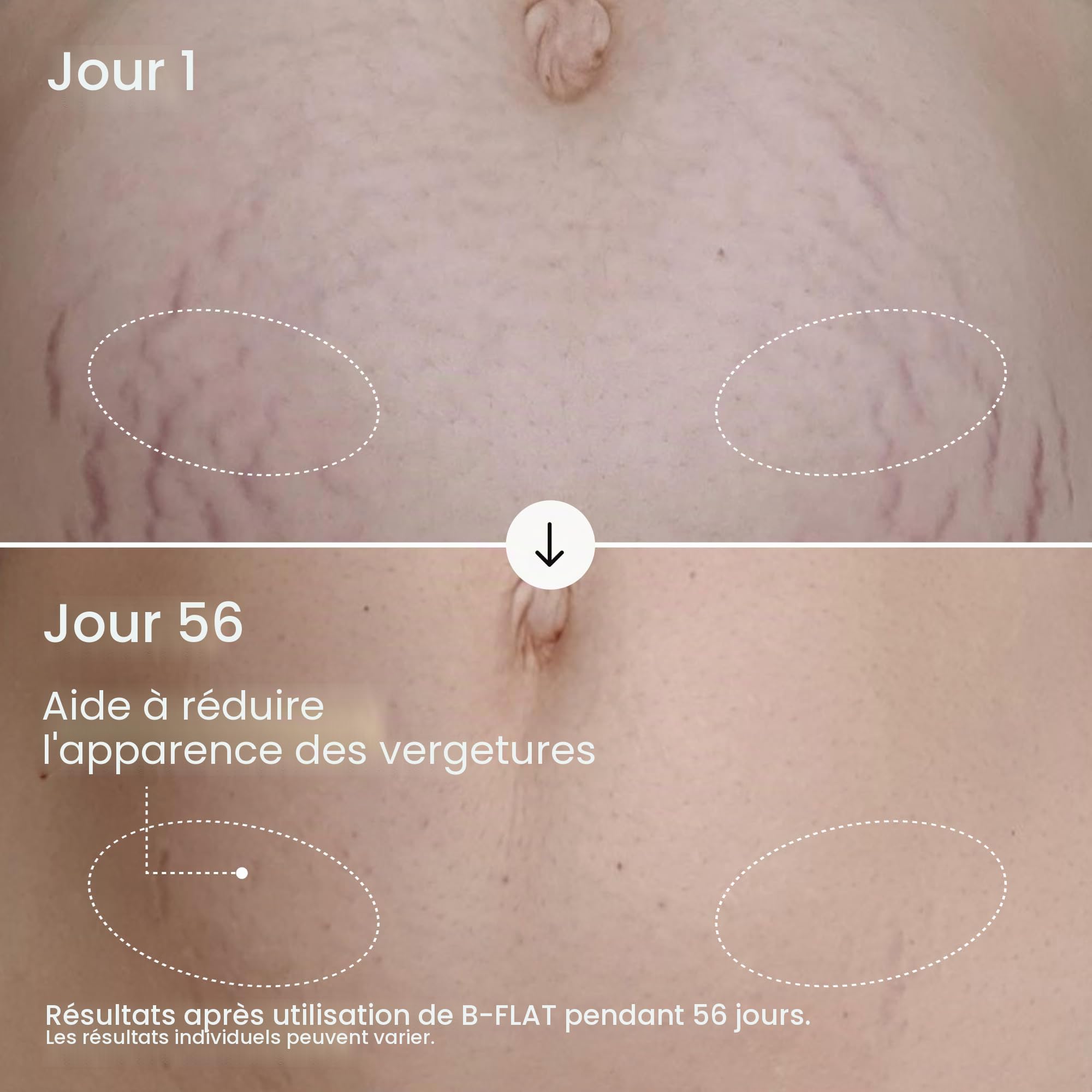 B-Flat Cellulite Stretch Marks Firming Cream | Belly Skin Treatment | Anti-Cellulite Stomach Lotion with Arabica Coffee & Hyaluronic Acid