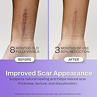 Vista 6 de AWD Cinta de silicona para cicatrices de 120 pulgadas de largo, hojas de silicona para cicatrices quirúrgicas, sección C, queloide, cinta