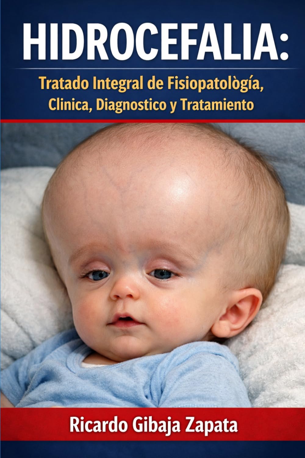Hidrocefalia: Tratado Integral de Fisiopatología, Clínica, Diagnóstico y Tratamiento