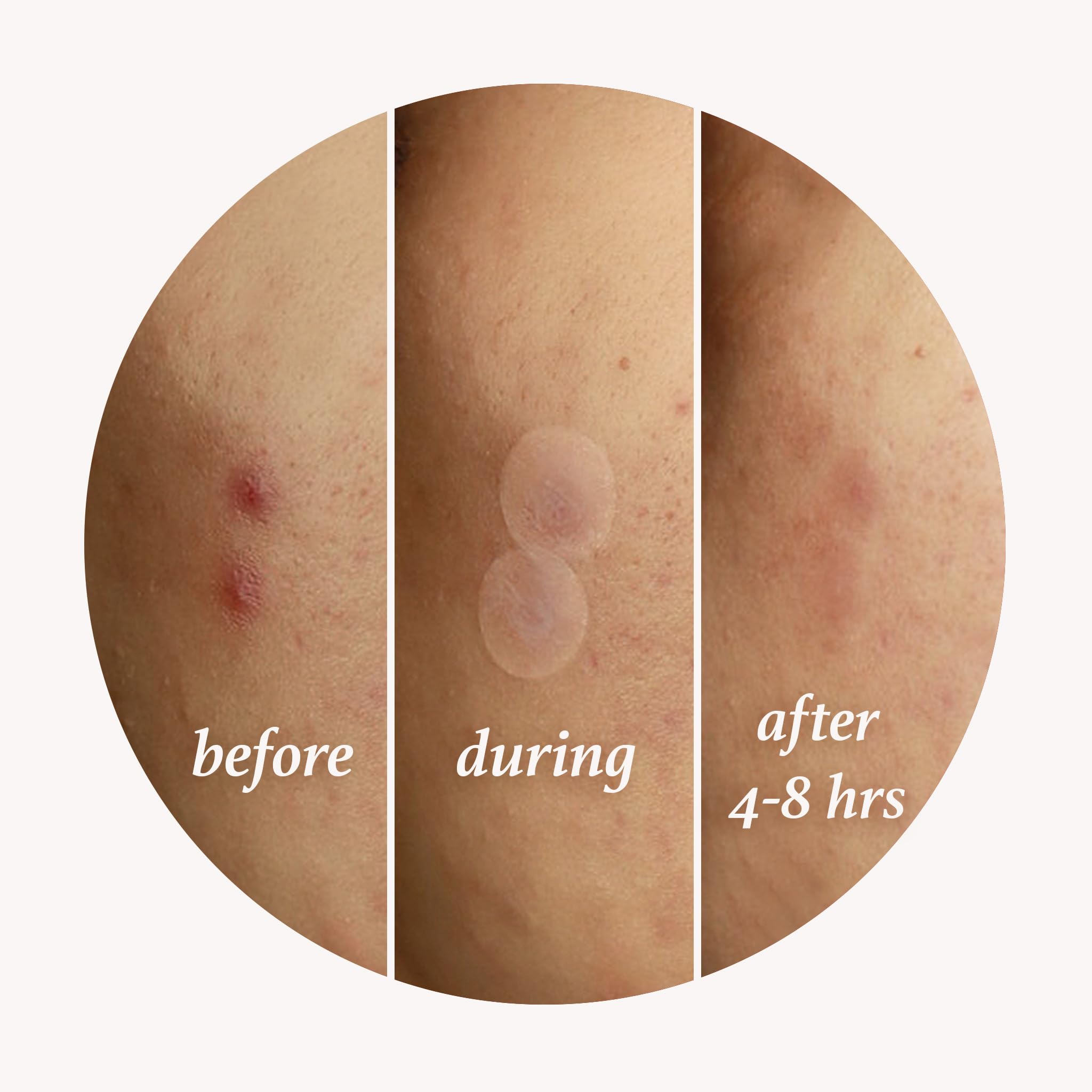 Julep Patch Me Up Waterproof Pimple Patches, Invisible Hydrocolloid Patch for Face Acne & Spot Treatment With Tea Tree Oil - Image 4