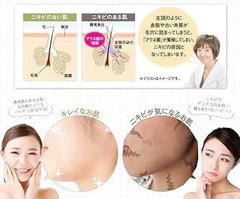 Amazon | TE:ATE (テアテ) ニキビケア 化粧水 (医薬部外品) | 薬院