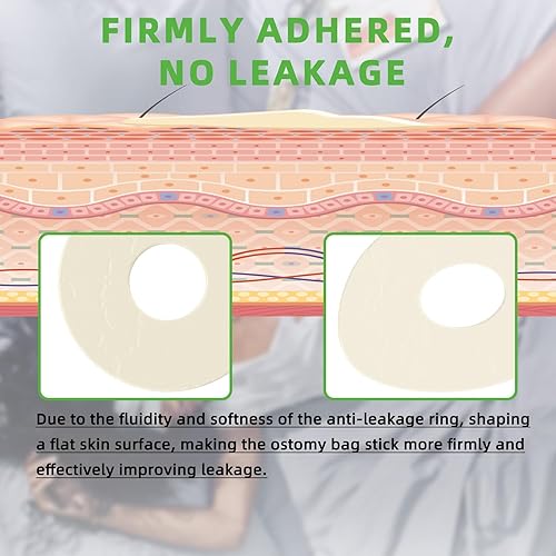 Miniatura 5 de 10 anillos de barrera para ostomía, suministros de ostomía de 0.157 in sin fugas, anillos extensores de piel hidrocoloides para bolsas de