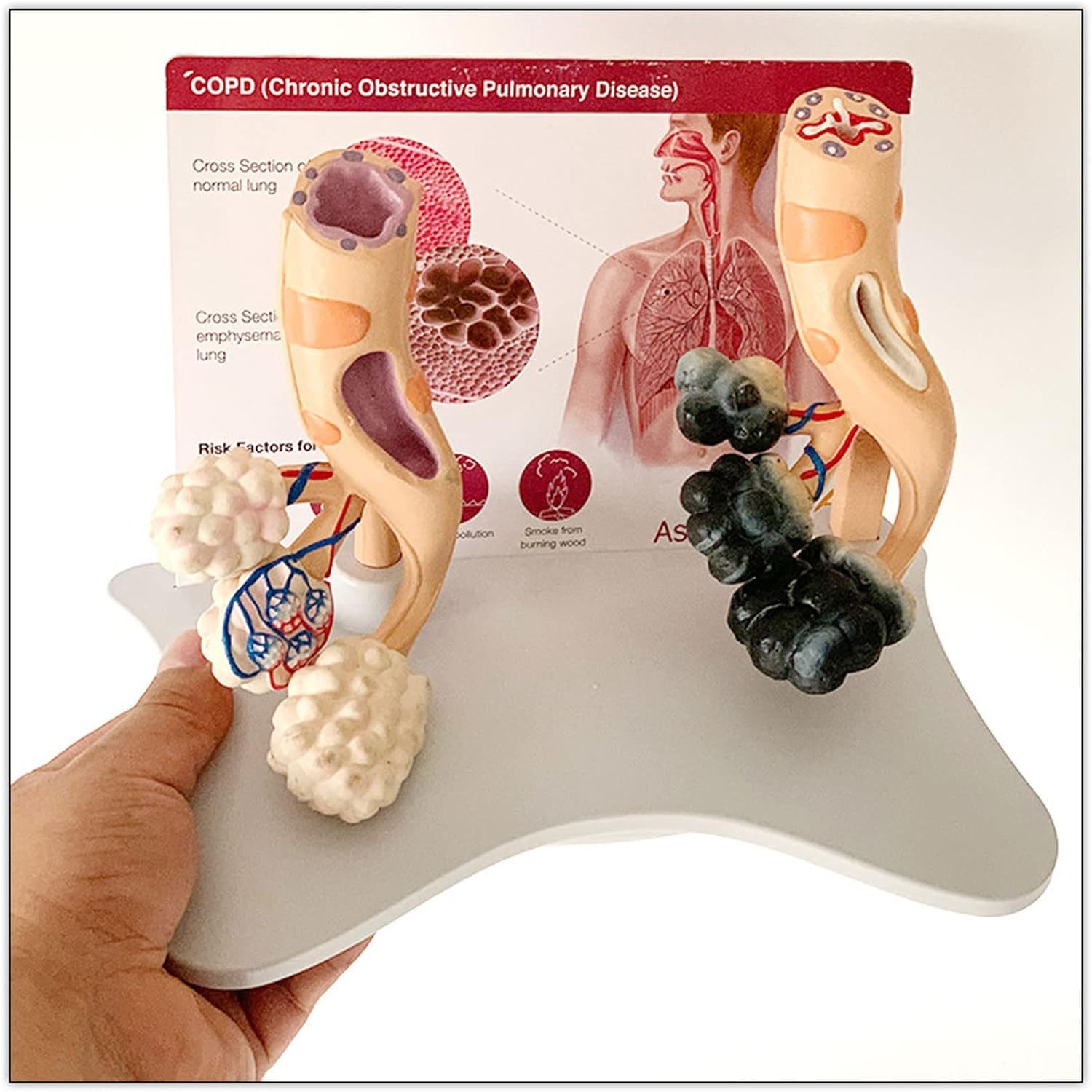 Modèle alvéolaire de la santé pulmonaire chez le fumeur, modèle de poumon sain, avec caractéristiques pathologiques et structure anatomique précise pour les effets du tabagisme sur la santé pulmonaire