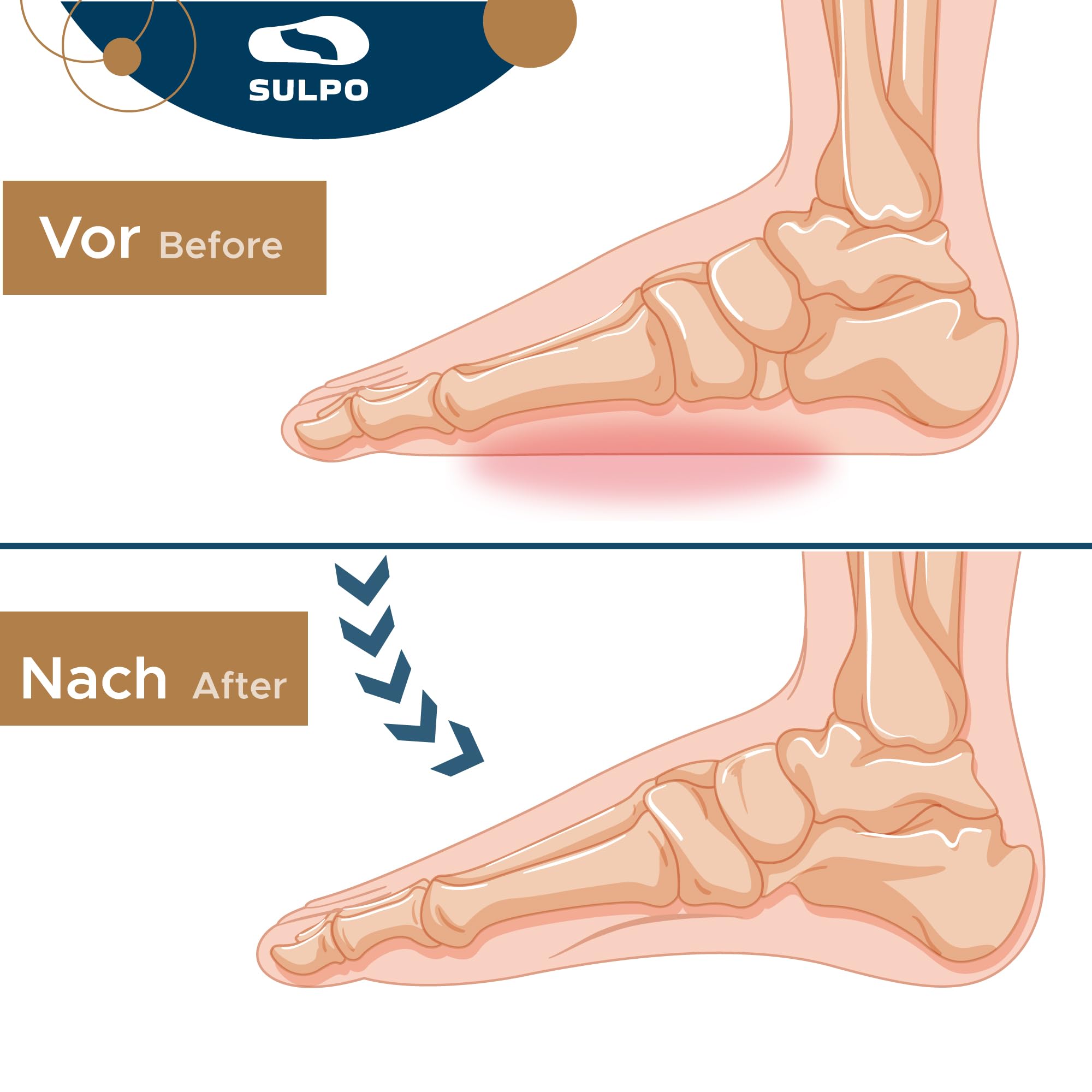 SULPO Talloniera per spina calcaneare - 3/4 Solette ortopediche per tallonite e piedi piatti - Proteggi tallone per scarpe - Cuscinetti tallone per fascite plantare e il dolore ai piedi - 36-39 / M