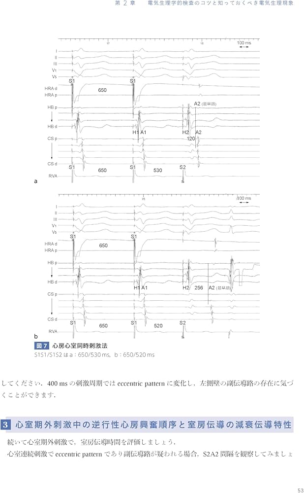 Amazon.co.jp: EPSとSVT―心臓電気生理学的検査と上室頻拍 : 永嶋孝一