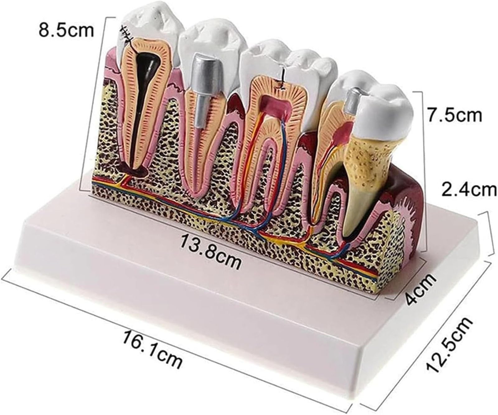 Tooth Model, Dental Caries Tooth Model,Teeth Cross-Section Model Gums Model Anatomy Teeth Model Detachable Education Dental Model for Students