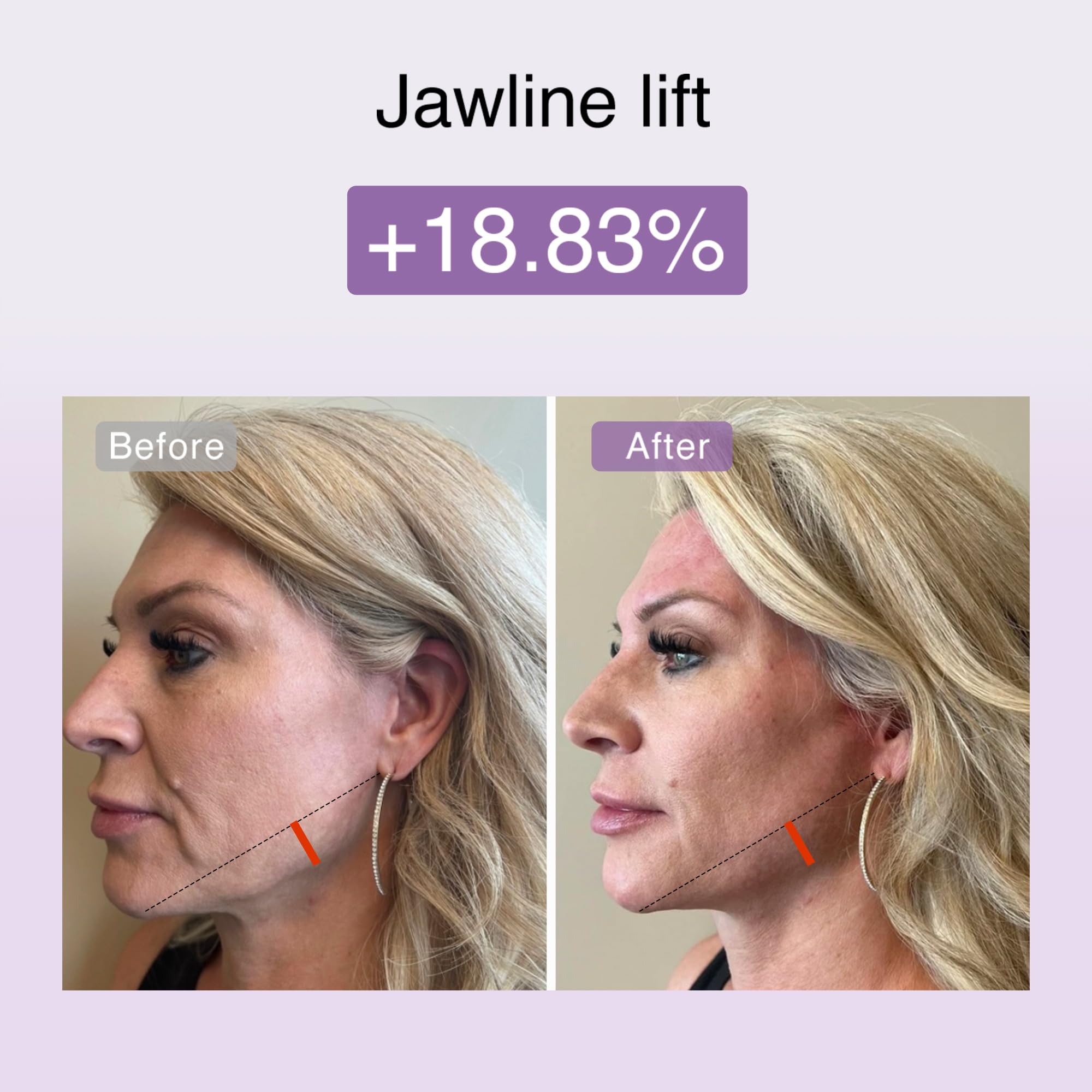 DermRays Neue Kosmetik M1,4 Limo Little Face, Leds Red Light, Leds Geräte, Die für Anti-aging Sorgen, Gesicht Strafft, Falten, Brust Und Ausstrahlung