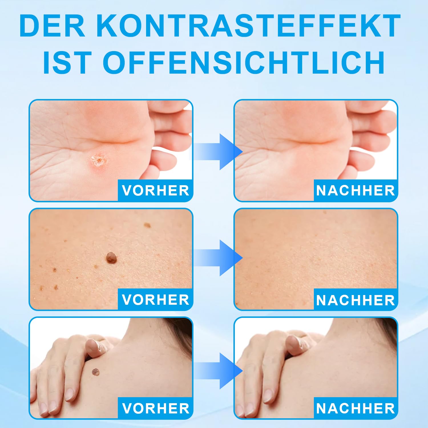 Sanfte Warzenentfernung für Gesicht & Körper - Schnell wirkendes Serum mit Präzisionsbürstenkopf gegen Hautirritationen, Dornwarzen & Flachwarzen, Sanfte Formel für sensible Haut, Reisegröße (2.5ml)