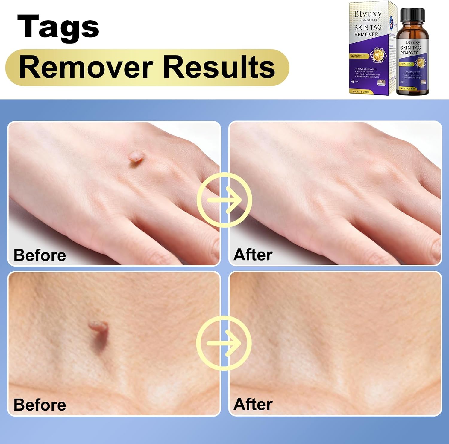 Fast-Acting Skin Tag Remover with Salicylic Acid, With a Precision Brush, Natural & Advanced Formula, Mild & non irritating, Suitable for All Skin Types,Efficiently & Painless Remover Tags, 30ml