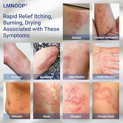 Miniatura 2 de Crema para eccema para piel seca, picazón, irritada y propensa al eccema, ungüento de tratamiento de máxima fuerza para erupciones, psoriasis,