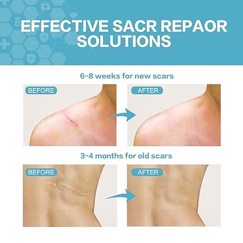 Miniatura 4 de Hojas de silicona para cicatrices (rollo de 1.6 x 120 pulgadas, 9.8 ft) cinta de silicona lavable de grado médico, hojas reutilizables para