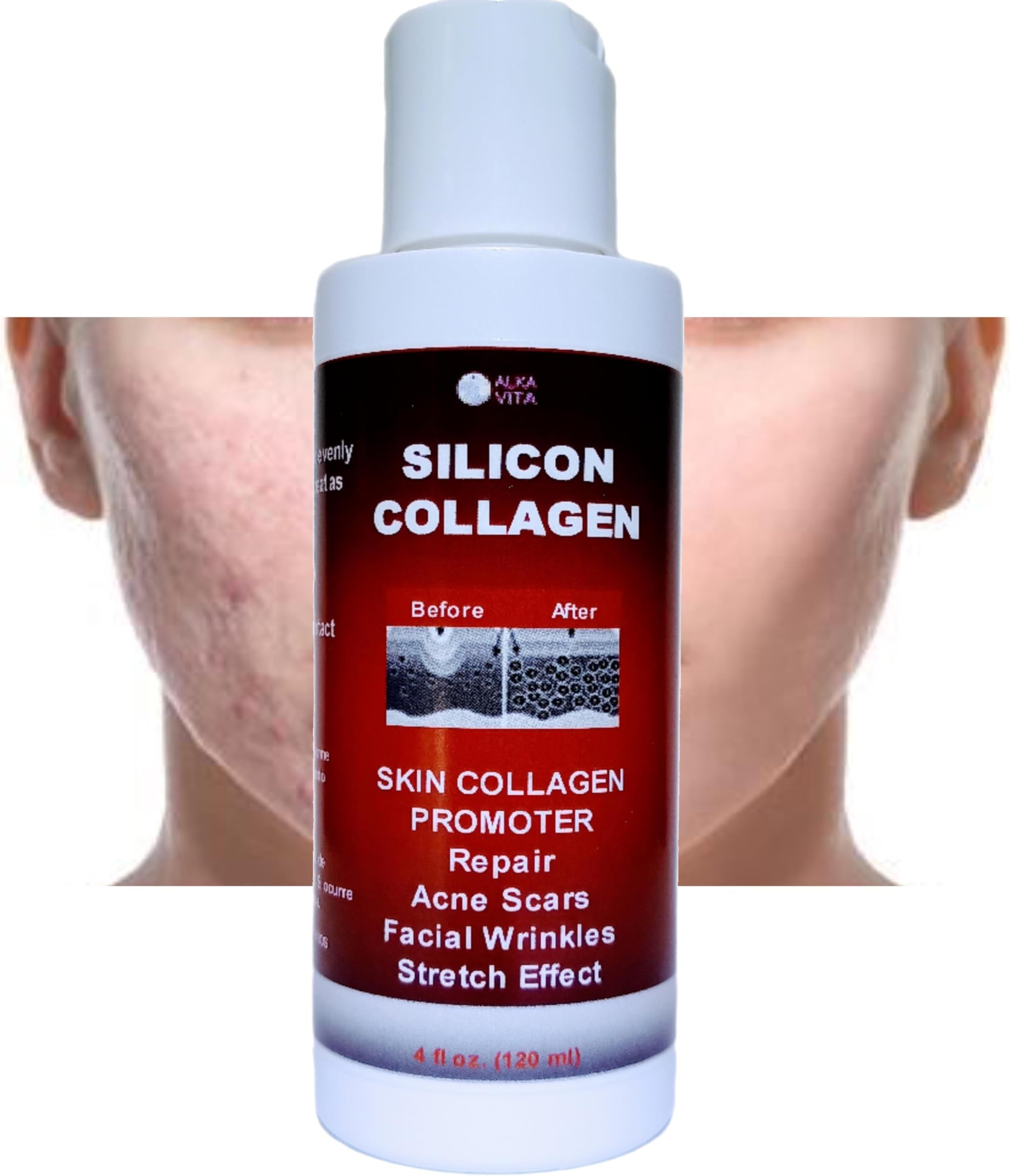 Acne Scars Silicon and Collagen Hydrolyzed Facial Gel Skin Resurfacing Indented By ALKA VITA