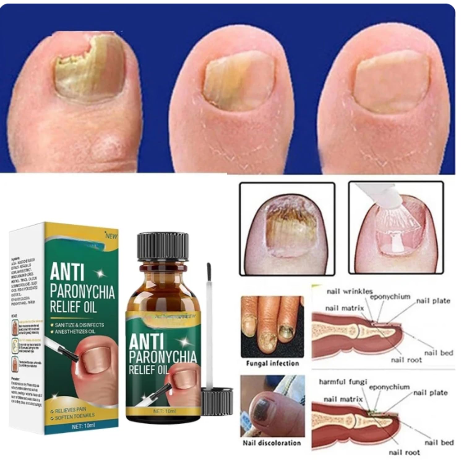 Nozti Anti Paronychia Relief Oil, 10ml, Natural Nail Treatment for Pain Relief and Disinfection - Image 6 thumbnail
