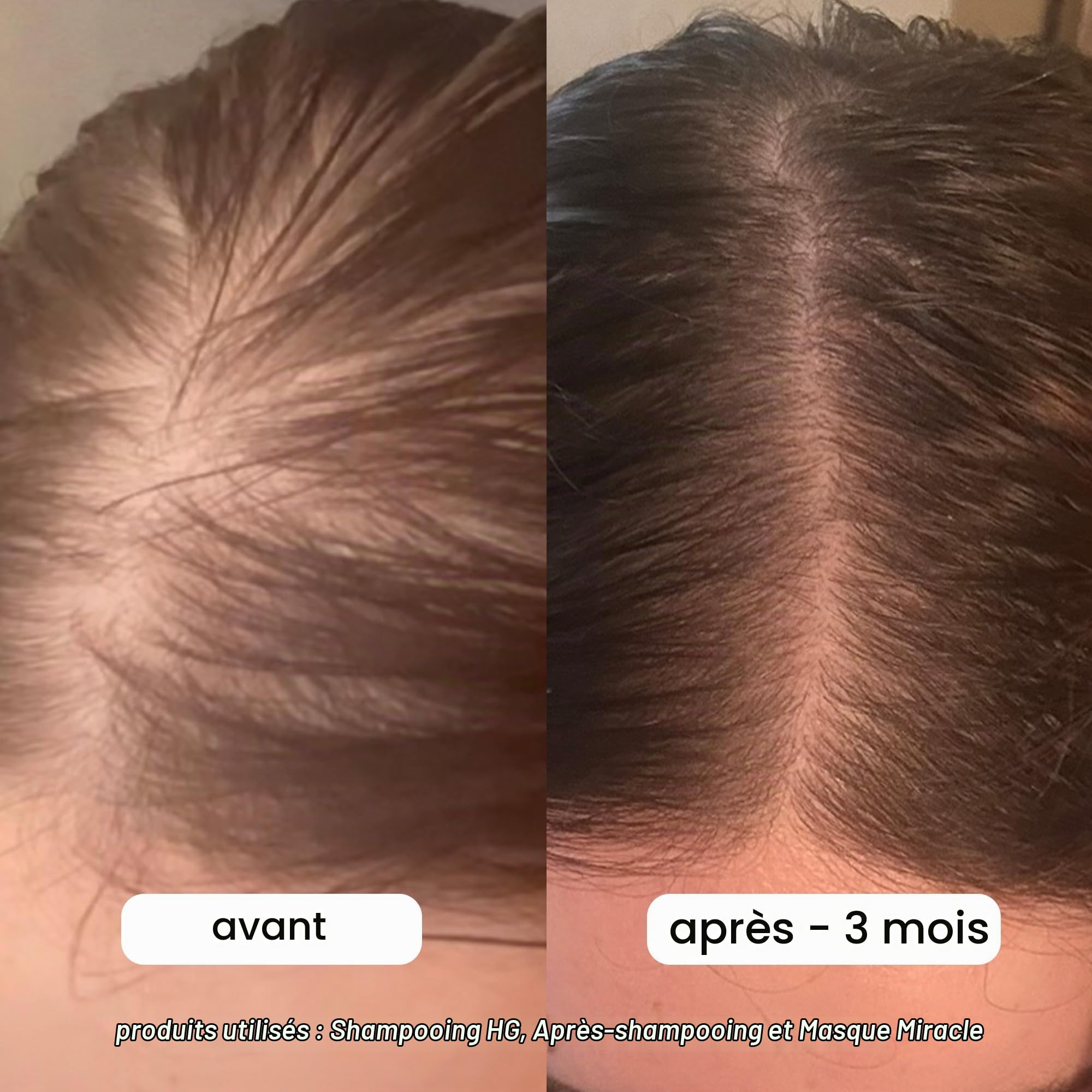 BONDIBOOST HG Duo Shampooing + Après-shampooing [300 ml chacun] – Améliore l'apparence des cheveux clairsemés – Volumateur + Hydratant + Nourrissant – Sans sulfate/paraben, pour femme/homme