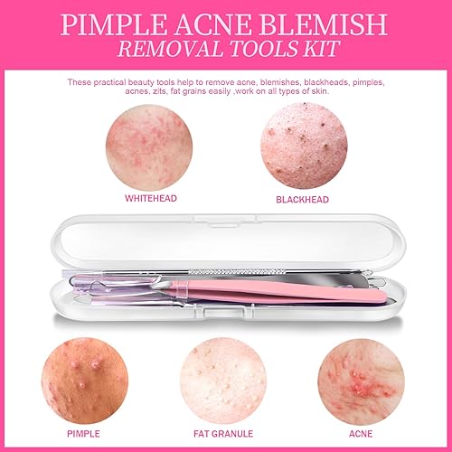 Miniatura 7 de Teenitor Kit de herramientas para eliminar puntos negros y reventador de espinillas, 2 extractores de puntos negros, 1 pinzas de pelo encarnado, 2
