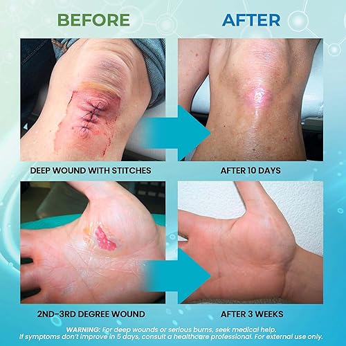 Miniatura 4 de Niebla para piel y heridas para enfermedades inflamadas de la piel y la herida  Natural, no tóxico y sin picadura  Ayuda con erupciones cutáneas,