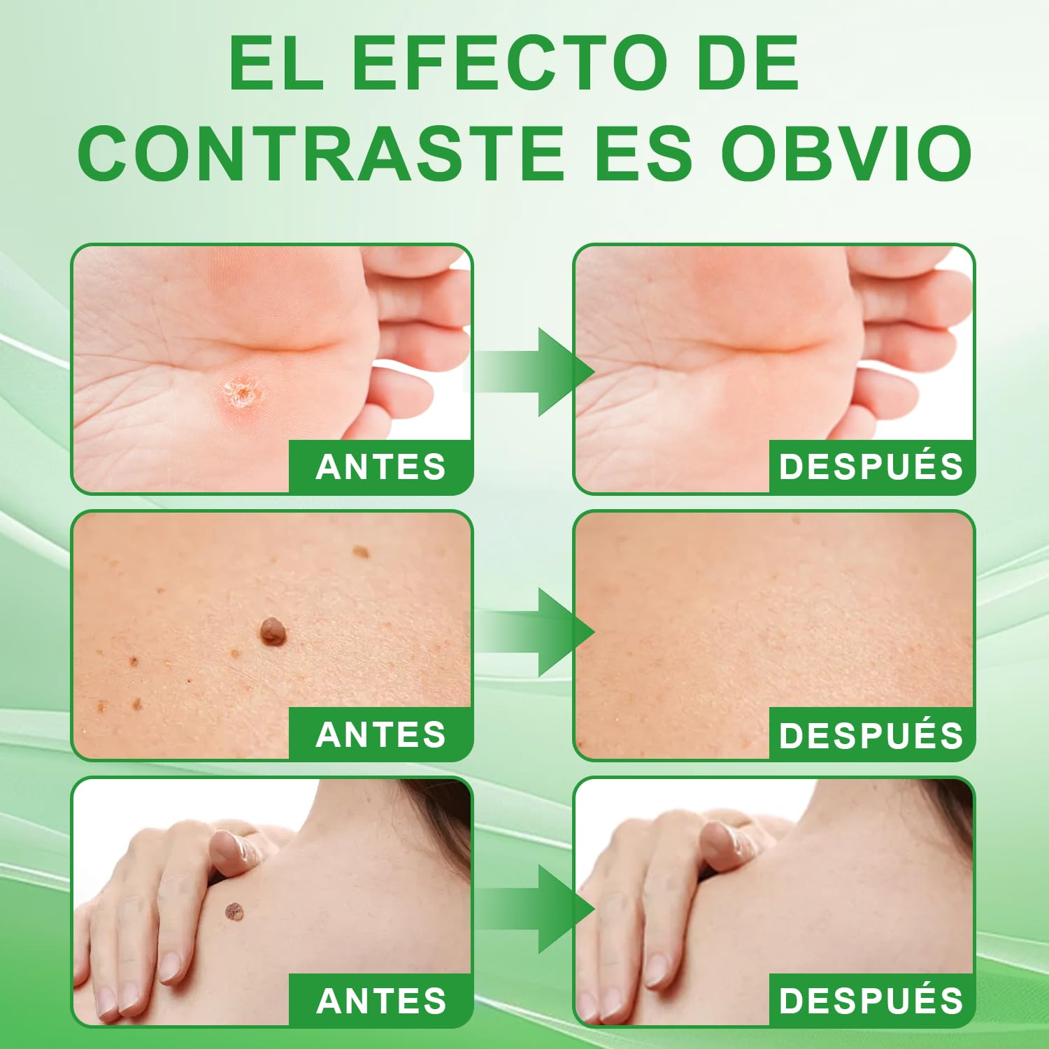 Removedor de verrugas de acción rápida para rostro y cuerpo - Lápiz con ácido salicílico y pincel de precisión | Fórmula suave para eliminar verrugas, tamaño viaje (4ml)