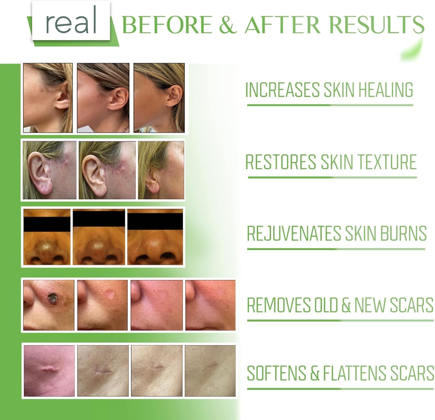 Dr. Speron's - 4th Gen - Natural Silicone Scar Gel – Promotes Natural Regenerative Activity, Clinically Shown to Make Scars Less Visible – 1.41 oz