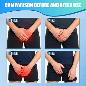 2pcs Jock Itch Cream Antifungal, Antifungal Cream for Private Parts, Anti Itch Cream for Men and Women, Helps Relieve Fungal Infections and Itching, 20g