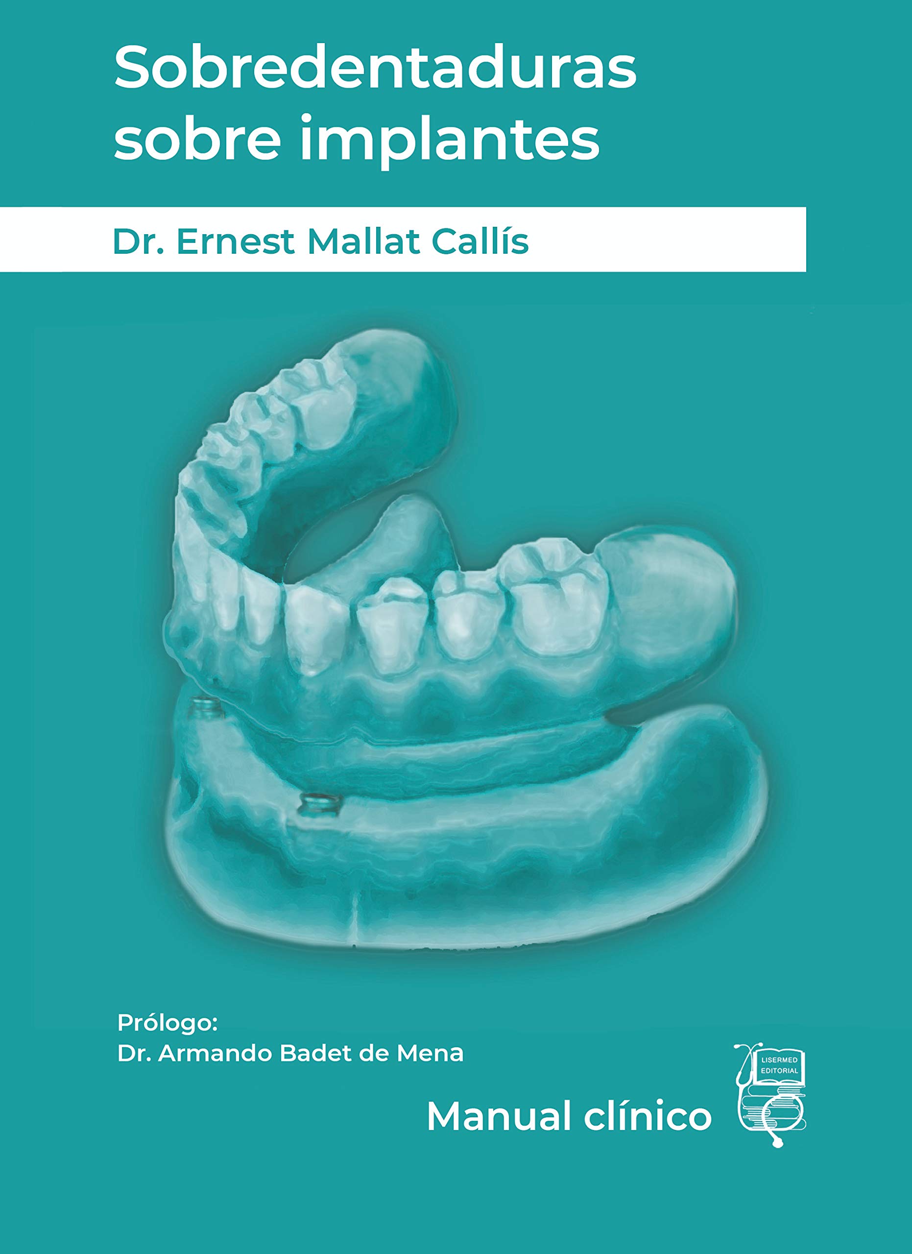 Sobredentaduras sobre implantes: Manual Clínico