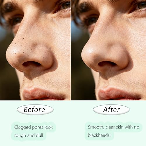 Miniatura 4 de 2 herramientas removedoras de puntos negros de doble cabeza, espátula facial de doble cabeza y limpiador de poros para limpieza facial profunda,