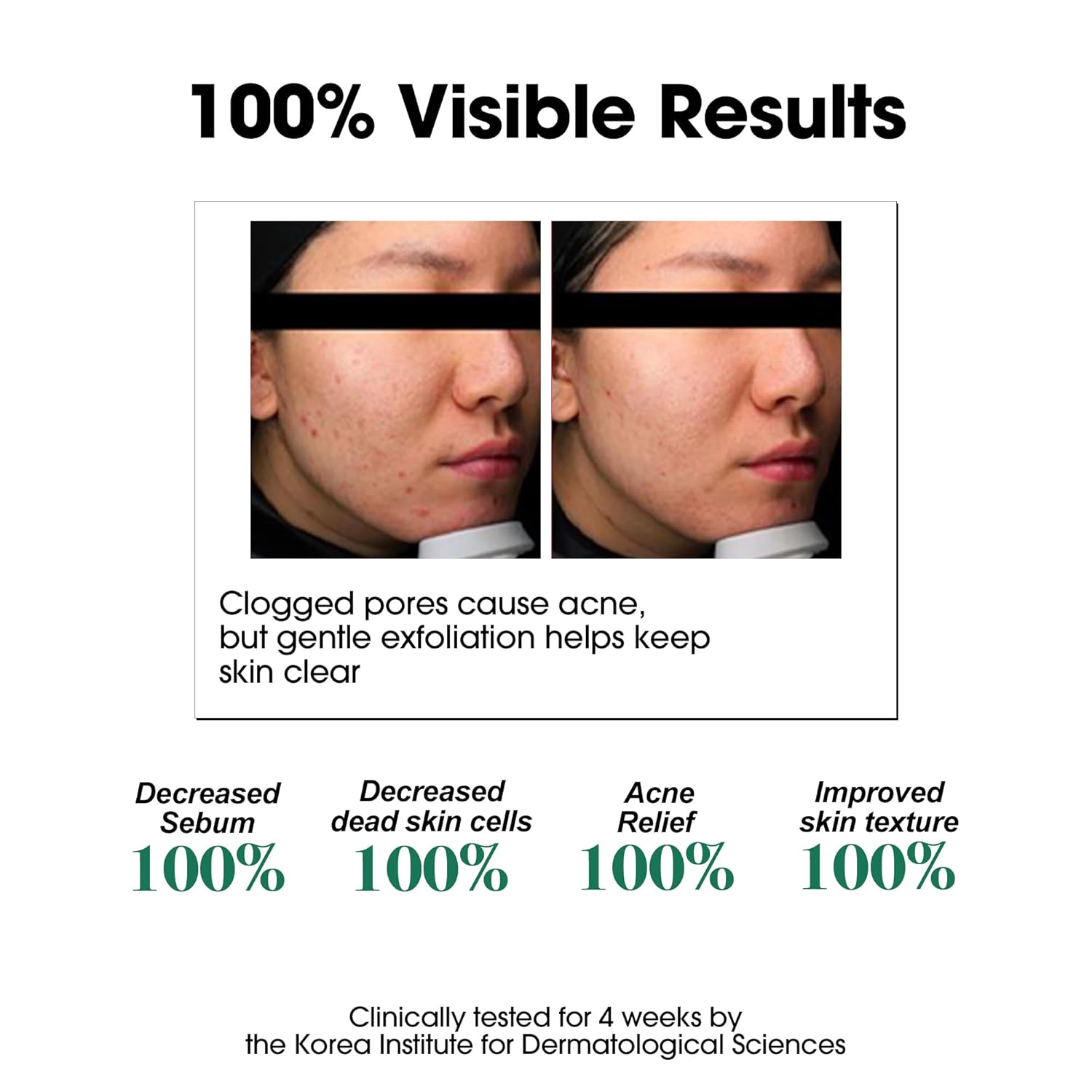 SOME BY MI AHA BHA PHA 30 Days Miracle Toner – 5.07oz, 150ml – Korean Salicylic Acid Exfoliating Face Toner for All Skin Types – Daily Pore Care & Oil Control with 2% Niacinamide – Korean Skin Care - Image 4