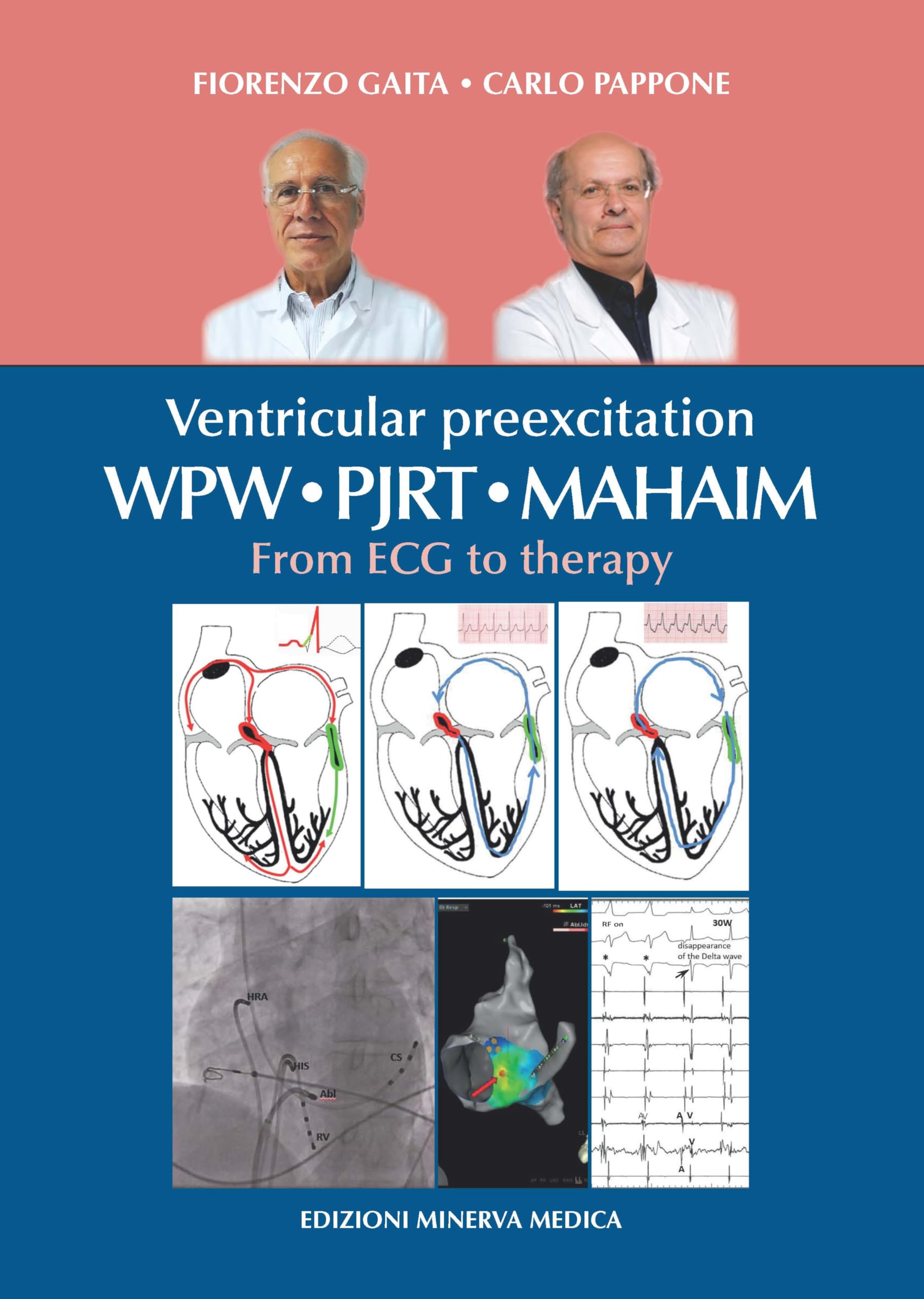 Ventricular preexcitation: WPW, PJRT, MAHAIM. From ECG to therapy