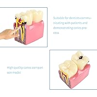 Vista 6 de Modelo de dientes de caries dentales Modelo de estudio comparativo de dientes de caries 6 veces, comparación bilateral de caries Modelo de dientes