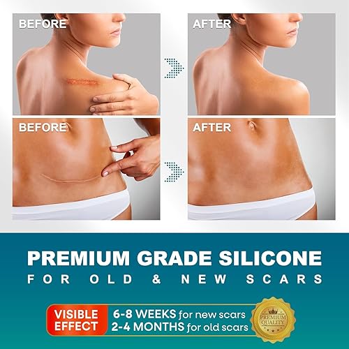Miniatura 2 de Hojas de silicona para cicatrices, cinta de silicona para cicatrices (rollo de 1.6 x 120 pulgadas, 118.1 in), cinta de silicona para cicatrices