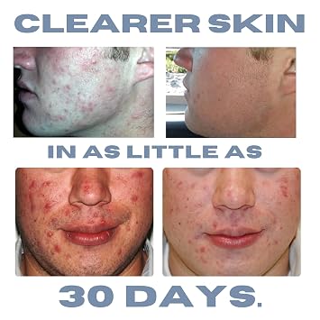 Clearogen Acne Lotion with Benzoyl Peroxide, Acne Cream, Face Moisturizer Acne Prone Skin, Acne Moisturizer for Face, 1.8 Fl oz