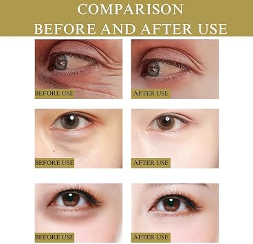 Nano Microneedle Patch for Eye,Dissolving Microneedle Eye Patches,Micro Needle Patches with Glycerin,Hyaluronic Acid-Anti-Wrinkle Under Eye Gel,Micro Needle Patches for Puffy Eyes&Dark Circles (8PCS)
