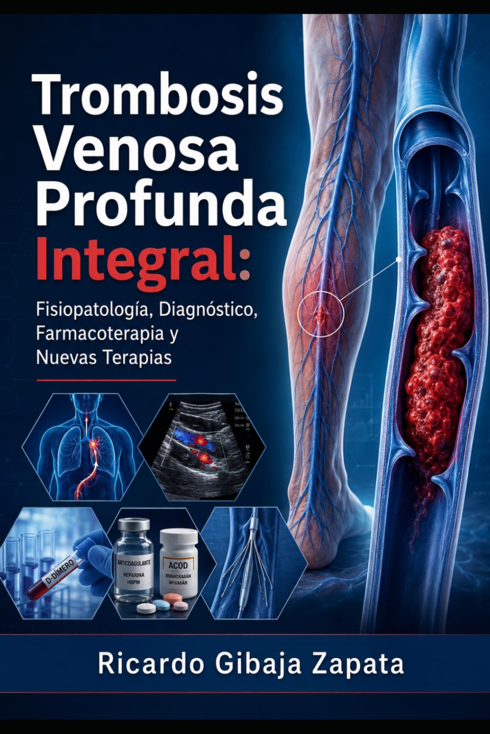 Trombosis Venosa Profunda Integral: Fisiopatología, Diagnóstico, Farmacoterapia y Nuevas Terapias