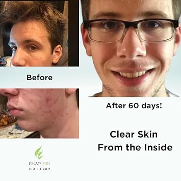 Clear Skin Acne Vitamin System | 20 Antioxidants, Botanicals & Minerals | 60 Count | Pack of 4 | 240 Total Capsules